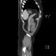 Ulcerative colitis, enterography: CT - Computed tomography